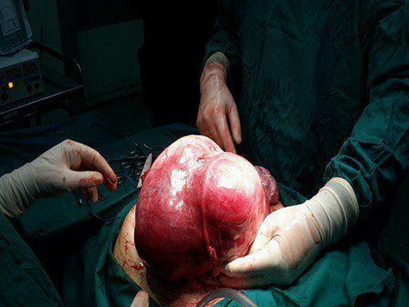 توده 5 کیلویی از شکم دختر کرمانشاهی خارج شد