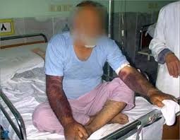هشدار درباە شیوع تب کنگو در عراق